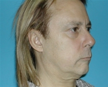 Facelift Before Photo by Jonathan Kramer, MD; Meridian, ID - Case 10531