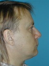 Facelift After Photo by Jonathan Kramer, MD; Meridian, ID - Case 10531