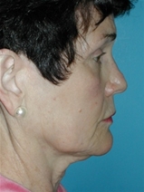 Facelift Before Photo by Jonathan Kramer, MD; Meridian, ID - Case 10532