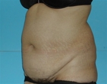 Tummy Tuck Before Photo by Jonathan Kramer, MD; Meridian, ID - Case 10533