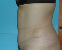 Tummy Tuck After Photo by Jonathan Kramer, MD; Meridian, ID - Case 10533