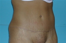 Tummy Tuck After Photo by Jonathan Kramer, MD; Meridian, ID - Case 20010