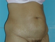 Tummy Tuck Before Photo by Jonathan Kramer, MD; Meridian, ID - Case 20010