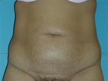 Tummy Tuck Before Photo by Jonathan Kramer, MD; Meridian, ID - Case 20010