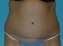 Tummy Tuck After Photo by Jonathan Kramer, MD; Meridian, ID - Case 20011