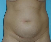 Tummy Tuck Before Photo by Jonathan Kramer, MD; Meridian, ID - Case 20011