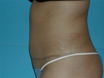 Tummy Tuck After Photo by Jonathan Kramer, MD; Meridian, ID - Case 20011