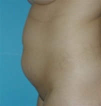 Tummy Tuck Before Photo by Jonathan Kramer, MD; Meridian, ID - Case 20011