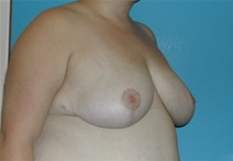 Breast Reduction After Photo by Jonathan Kramer, MD; Meridian, ID - Case 20015