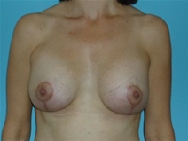 Breast Lift After Photo by Jonathan Kramer, MD; Meridian, ID - Case 20018