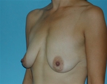 Breast Lift Before Photo by Jonathan Kramer, MD; Meridian, ID - Case 20018