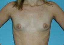 Breast Augmentation Before Photo by Jonathan Kramer, MD; Meridian, ID - Case 20050