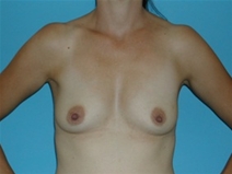 Breast Augmentation Before Photo by Jonathan Kramer, MD; Meridian, ID - Case 20052