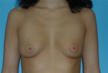 Breast Augmentation Before Photo by Jonathan Kramer, MD; Meridian, ID - Case 20053