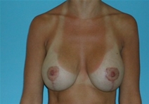Breast Lift After Photo by Jonathan Kramer, MD; Meridian, ID - Case 20054