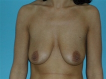 Breast Lift Before Photo by Jonathan Kramer, MD; Meridian, ID - Case 20054
