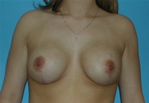 Breast Lift After Photo by Jonathan Kramer, MD; Meridian, ID - Case 20055