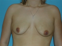 Breast Lift Before Photo by Jonathan Kramer, MD; Meridian, ID - Case 20055