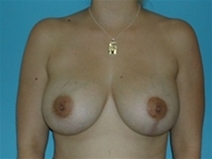 Breast Lift After Photo by Jonathan Kramer, MD; Meridian, ID - Case 20056