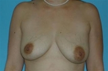 Breast Lift Before Photo by Jonathan Kramer, MD; Meridian, ID - Case 20056