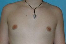 Male Breast Reduction After Photo by Jonathan Kramer, MD; Meridian, ID - Case 20164