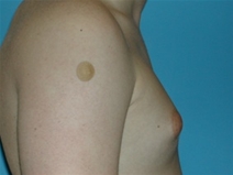 Male Breast Reduction Before Photo by Jonathan Kramer, MD; Meridian, ID - Case 20164