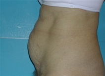 Tummy Tuck Before Photo by Jonathan Kramer, MD; Meridian, ID - Case 20165