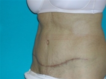 Tummy Tuck After Photo by Jonathan Kramer, MD; Meridian, ID - Case 20165