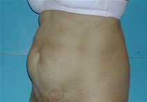 Tummy Tuck Before Photo by Jonathan Kramer, MD; Meridian, ID - Case 20165