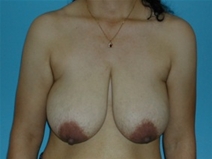 Breast Reduction Before Photo by Jonathan Kramer, MD; Meridian, ID - Case 20932