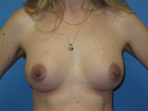 Breast Augmentation After Photo by Jonathan Kramer, MD; Meridian, ID - Case 20936