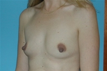 Breast Augmentation Before Photo by Jonathan Kramer, MD; Meridian, ID - Case 20936
