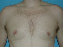 Male Breast Reduction After Photo by Jonathan Kramer, MD; Meridian, ID - Case 20946