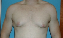 Male Breast Reduction Before Photo by Jonathan Kramer, MD; Meridian, ID - Case 20946