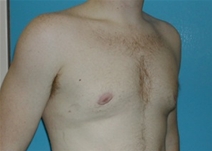 Male Breast Reduction After Photo by Jonathan Kramer, MD; Meridian, ID - Case 20946