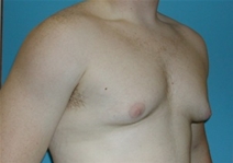 Male Breast Reduction Before Photo by Jonathan Kramer, MD; Meridian, ID - Case 20946