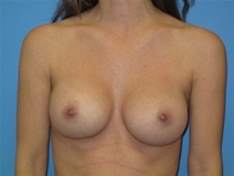 Breast Augmentation After Photo by Jonathan Kramer, MD; Meridian, ID - Case 22757