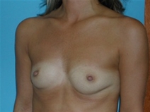Breast Augmentation Before Photo by Jonathan Kramer, MD; Meridian, ID - Case 22757