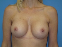 Breast Augmentation After Photo by Jonathan Kramer, MD; Meridian, ID - Case 22758