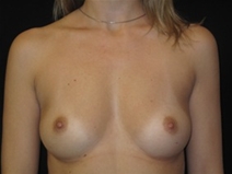 Breast Augmentation Before Photo by Jonathan Kramer, MD; Meridian, ID - Case 22759