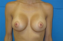 Breast Augmentation After Photo by Jonathan Kramer, MD; Meridian, ID - Case 22760