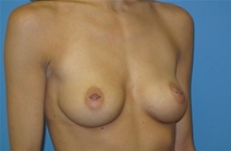 Breast Augmentation Before Photo by Jonathan Kramer, MD; Meridian, ID - Case 22760