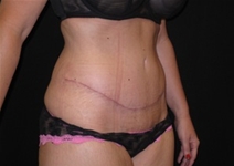 Tummy Tuck After Photo by Jonathan Kramer, MD; Meridian, ID - Case 23465