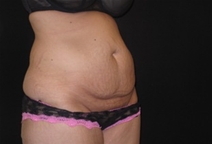 Tummy Tuck Before Photo by Jonathan Kramer, MD; Meridian, ID - Case 23465
