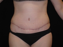 Tummy Tuck After Photo by Jonathan Kramer, MD; Meridian, ID - Case 23466