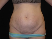 Tummy Tuck Before Photo by Jonathan Kramer, MD; Meridian, ID - Case 23466