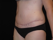 Tummy Tuck After Photo by Jonathan Kramer, MD; Meridian, ID - Case 23466