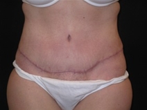 Tummy Tuck After Photo by Jonathan Kramer, MD; Meridian, ID - Case 23467