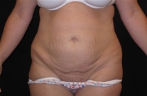 Tummy Tuck Before Photo by Jonathan Kramer, MD; Meridian, ID - Case 23467
