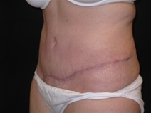 Tummy Tuck After Photo by Jonathan Kramer, MD; Meridian, ID - Case 23467